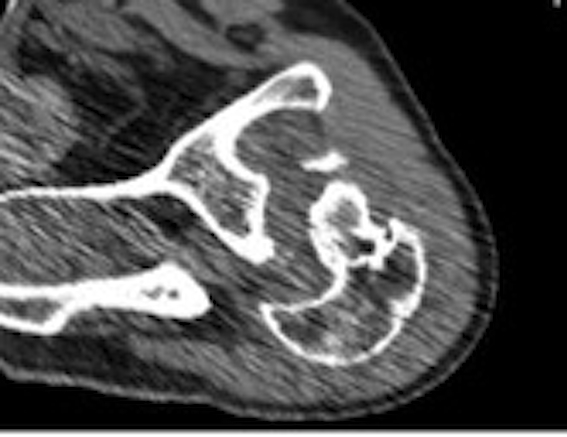 Posterior Shoulder Dislocation CT